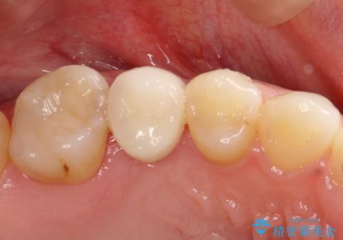 隙間が気になる。審美性の高いインプラント治療の治療後