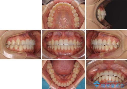 短期間で治療したい　目立たないワイヤー装置での非抜歯矯正の治療後