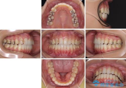 後戻りを治したい 骨格的なズレの大きい方のインビザライン矯正の治療後