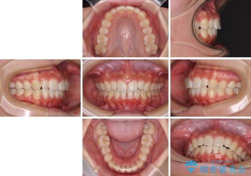 前歯のデコボコを治したい インビザラインによる矯正治療の治療後