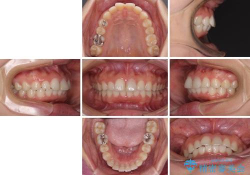 矯正治療の後戻り　ガタガタになった前歯の部分矯正の治療後