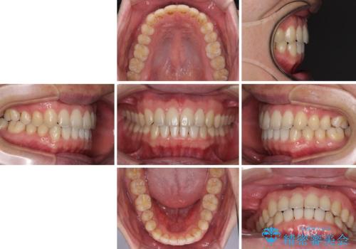 すきっ歯の改善　インビザライン矯正治療の治療後