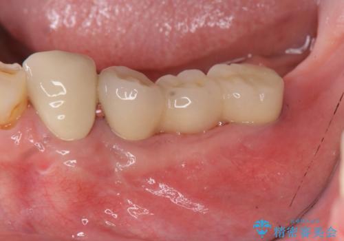 入れ歯で食事が楽しくなくなった。インプラントでまたしっかりとかみたい