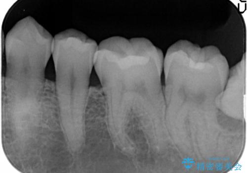 メタルフリー セラミックインレーの治療後