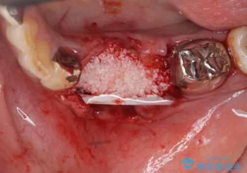 [歯の破折] インプラント埋入を行うための大規模骨造成の治療前