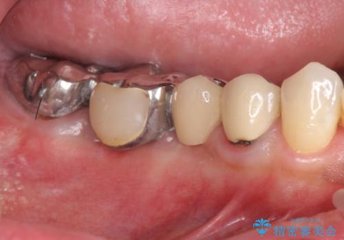 銀歯だらけの口の中を改善したいの治療前