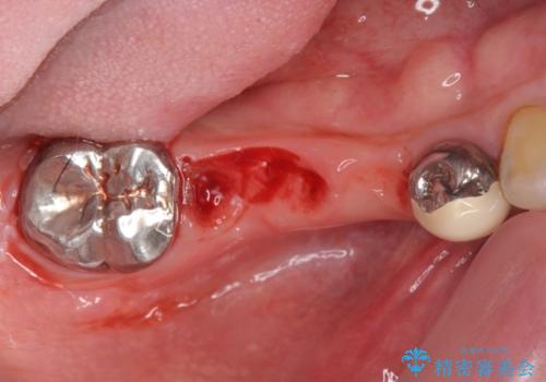 銀歯だらけの口の中を改善したいの治療前