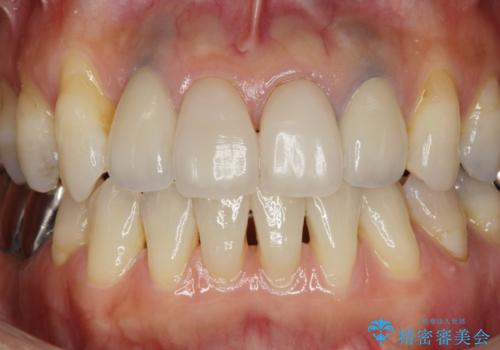 歯ぐきの黒ずみ クラウンやりかえによる改善の治療後