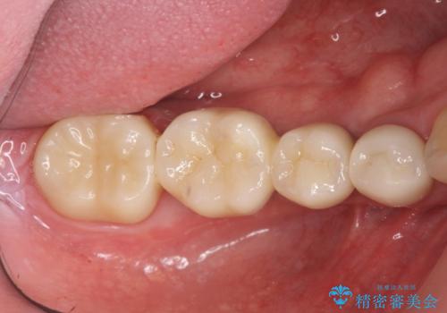 銀歯だらけの口の中を改善したいの治療後