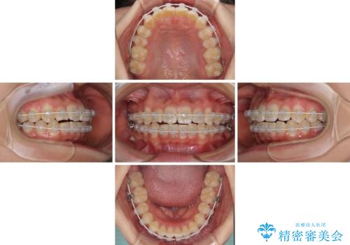 短期間で治療したい　目立たないワイヤー装置での非抜歯矯正の治療中