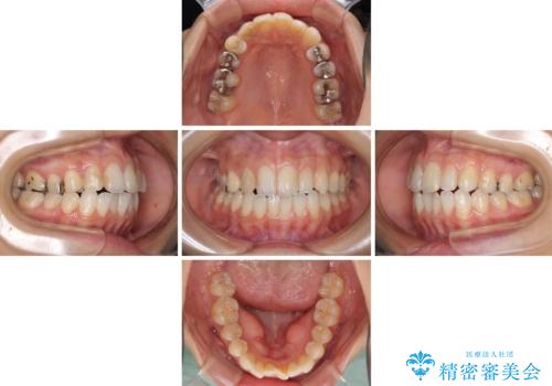 後戻りを治したい 骨格的なズレの大きい方のインビザライン矯正の治療中