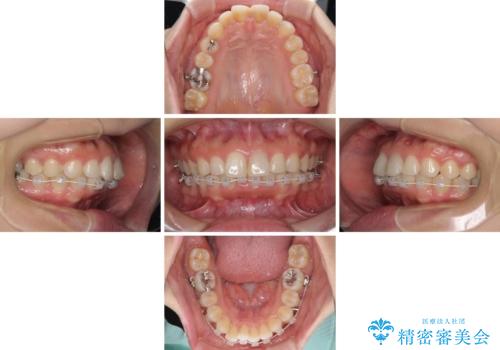 矯正治療の後戻り　ガタガタになった前歯の部分矯正の治療中