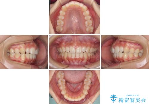 前歯のデコボコを治したい インビザラインによる矯正治療の治療中