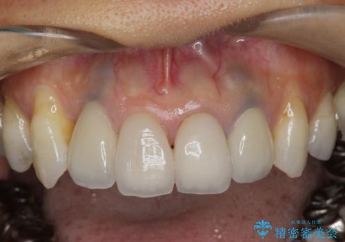 歯ぐきの黒ずみ クラウンやりかえによる改善の治療後