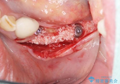 入れ歯で食事が楽しくなくなった。インプラントでまたしっかりとかみたいの治療前