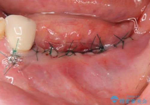 入れ歯で食事が楽しくなくなった。インプラントでまたしっかりとかみたいの治療前