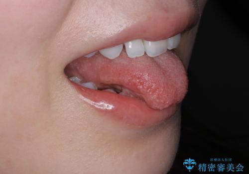 舌小帯の形成の治療前