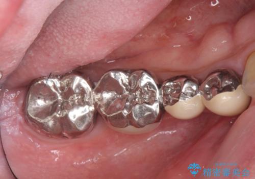 銀歯だらけの口の中を改善したいの治療前