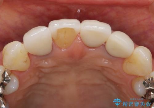 歯ぐきの黒ずみ クラウンやりかえによる改善の治療前