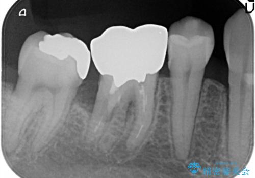 奥歯が痛い。ブリッジによる欠損補綴の治療前