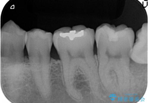 メタルフリー セラミックインレーの治療前