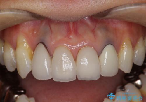 歯ぐきの黒ずみ クラウンやりかえによる改善の治療前