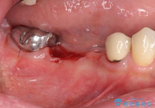 銀歯だらけの口の中を改善したいの治療前
