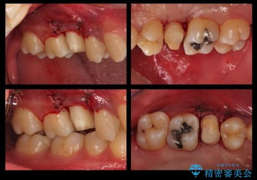 放置した虫歯 歯ぐきの中まで虫歯でも、しっかり健康的な部分を引っ張り出して、きちんと処置します。の治療中
