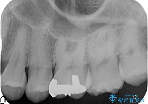 メタルフリー セラミックインレーの治療前
