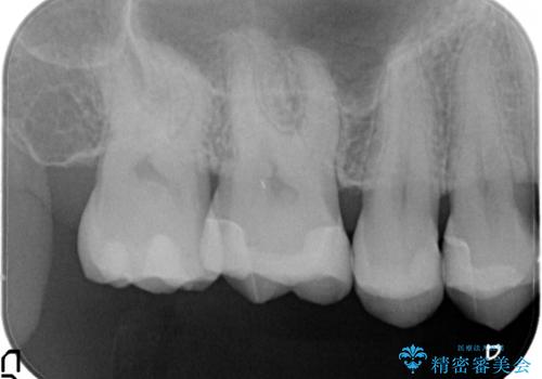 見た目が綺麗なセラミックインレーの治療後