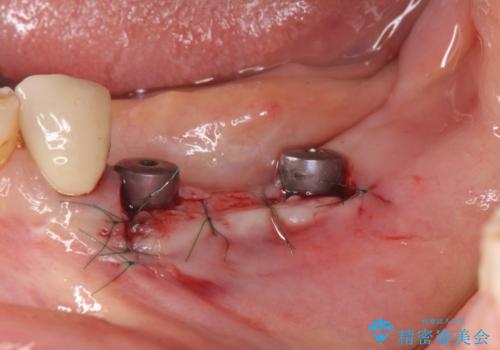 入れ歯で食事が楽しくなくなった。インプラントでまたしっかりとかみたいの治療中