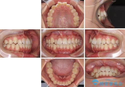 短期間で治療したい　目立たないワイヤー装置での非抜歯矯正の治療前