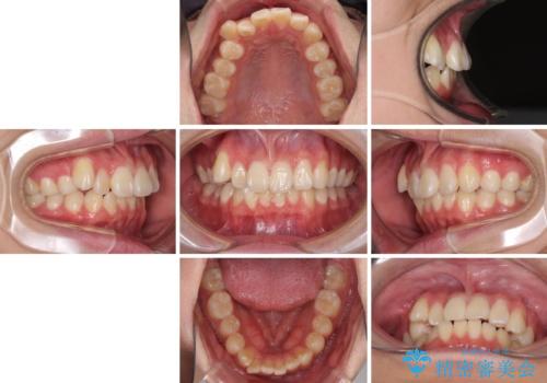 体育会系の部活をしながら　インビザラインを用いた矯正治療の治療前
