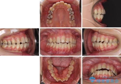 後戻りを治したい 骨格的なズレの大きい方のインビザライン矯正の治療前