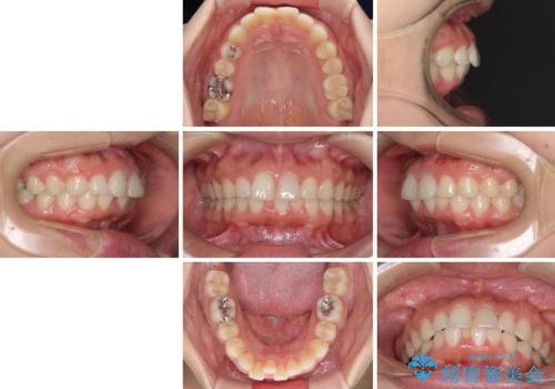 矯正治療の後戻り　ガタガタになった前歯の部分矯正の治療前