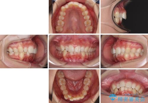 前歯のデコボコを治したい インビザラインによる矯正治療の治療前