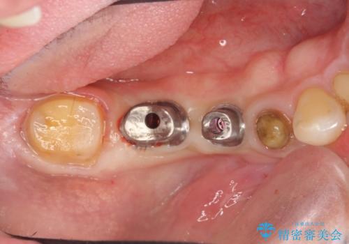 銀歯だらけの口の中を改善したいの治療中
