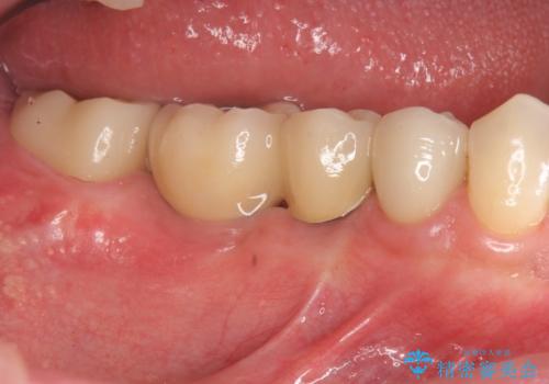 銀歯だらけの口の中を改善したいの症例 治療後