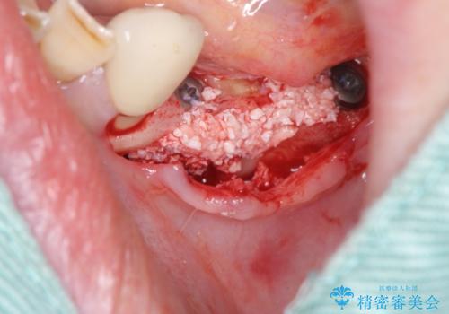 入れ歯で食事が楽しくなくなった。インプラントでまたしっかりとかみたいの治療前
