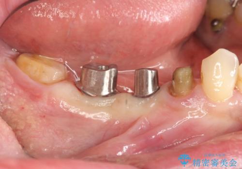 銀歯だらけの口の中を改善したいの治療中