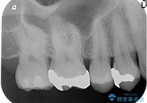 見た目が綺麗なセラミックインレーの治療前
