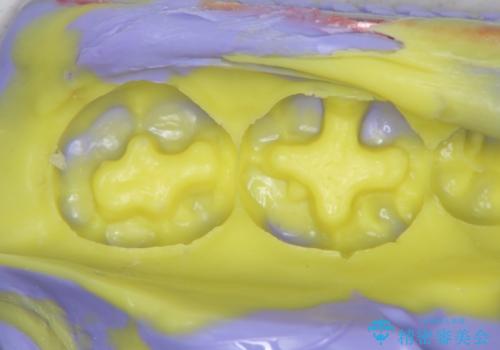 精密かつ審美的なセラミックインレーの治療中