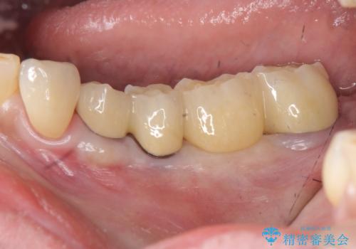 [歯の破折] インプラント埋入を行うための大規模骨造成の治療後