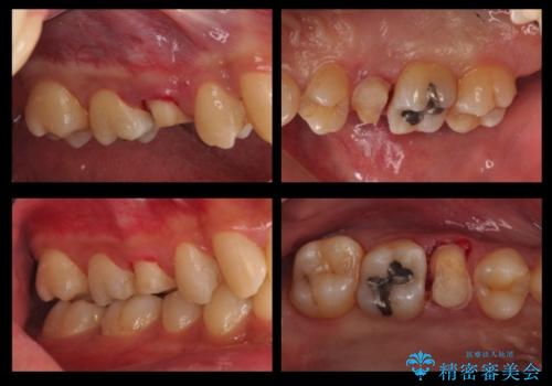 放置した虫歯 歯ぐきの中まで虫歯でも、しっかり健康的な部分を引っ張り出して、きちんと処置します。の治療中