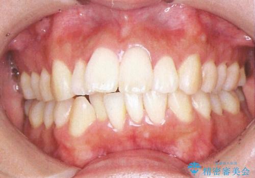 裏側装置で出っ歯の矯正治療の症例 治療前