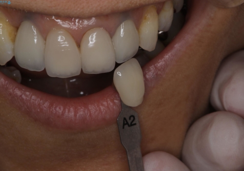 歯ぐきの黒ずみ クラウンやりかえによる改善の治療中