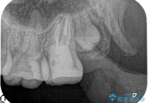 奥歯が痛い。ラバーダム使った治療がしたい。の治療後