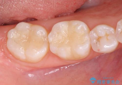 精密かつ審美的なセラミックインレーの治療後