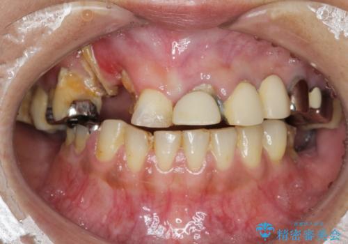 痛くて噛めない インプラントで全て治療したいの症例 治療前