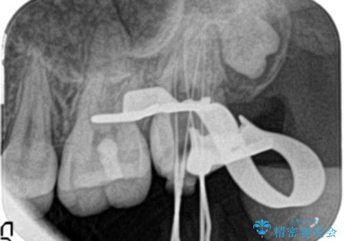奥歯が痛い。ラバーダム使った治療がしたい。の治療中